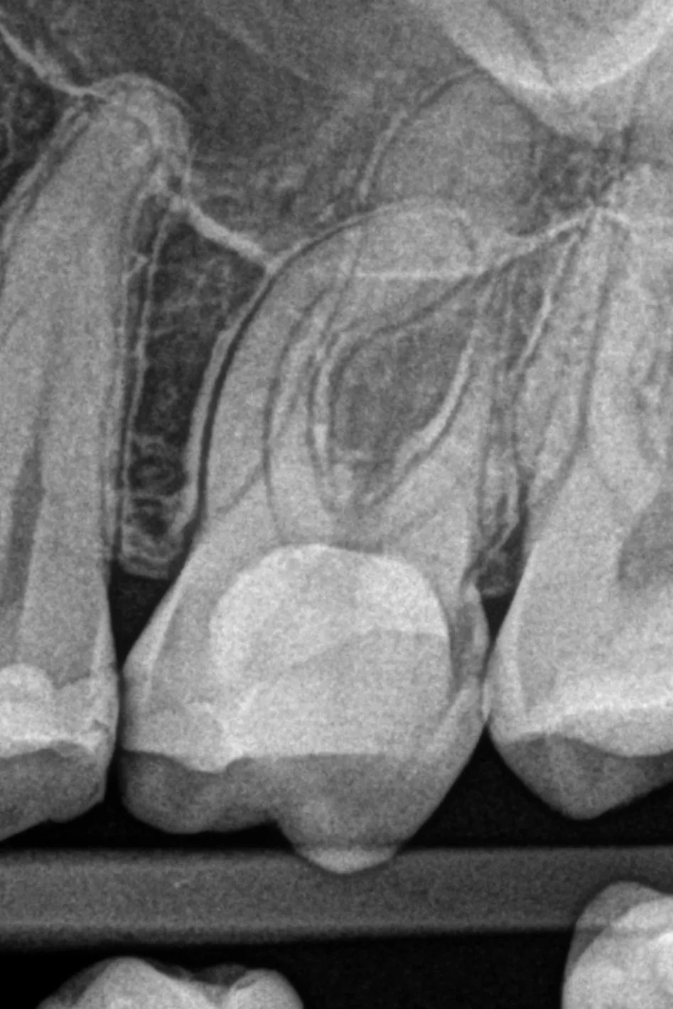 1 - Radiografie inițială - tratament de urgență inițiat anterior