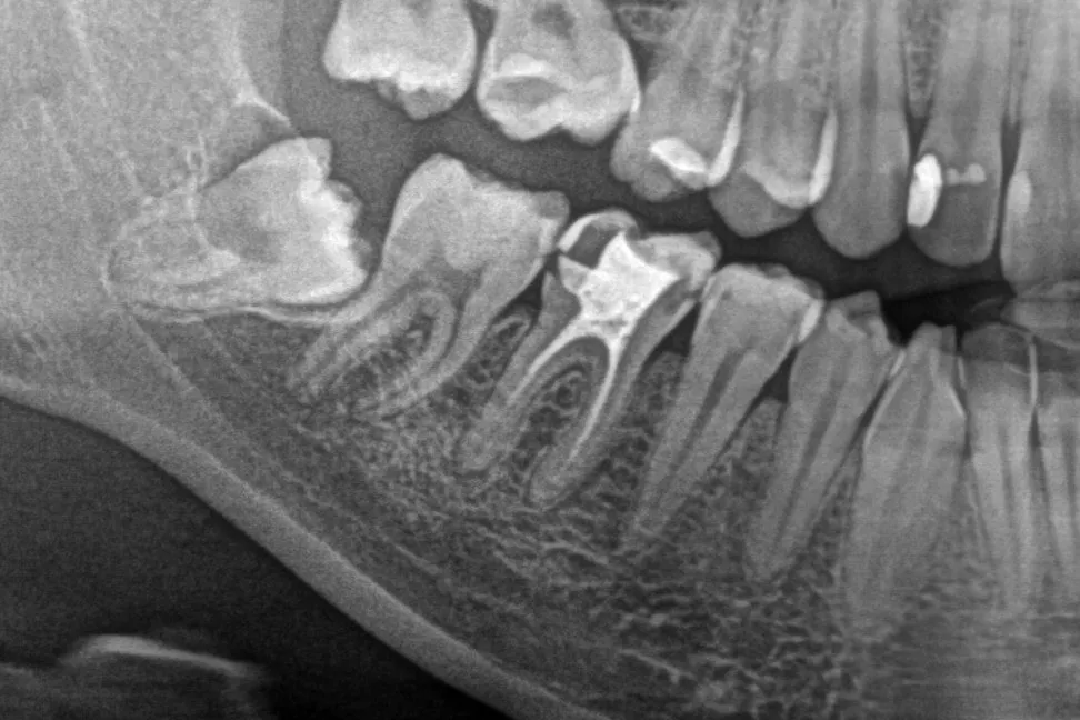 1 - Radiografie inițială - 4.6 tratat anterior, obturație coronară infiltrată, carie recidivă - secțiune OPT