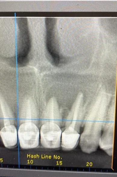 1 - Secțiune inițială CBCT 2.1 și 2.2: dinți tratați anterior, restaurare protetică, leziune periapicală de dimensiuni mari