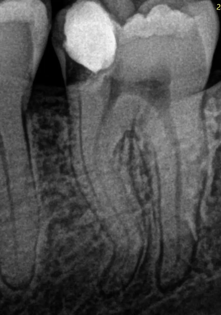 1 - Radiografie inițială 4.7: obturație coronară cu carie secundară și recidivă, inflamație pulpară ireversibilă