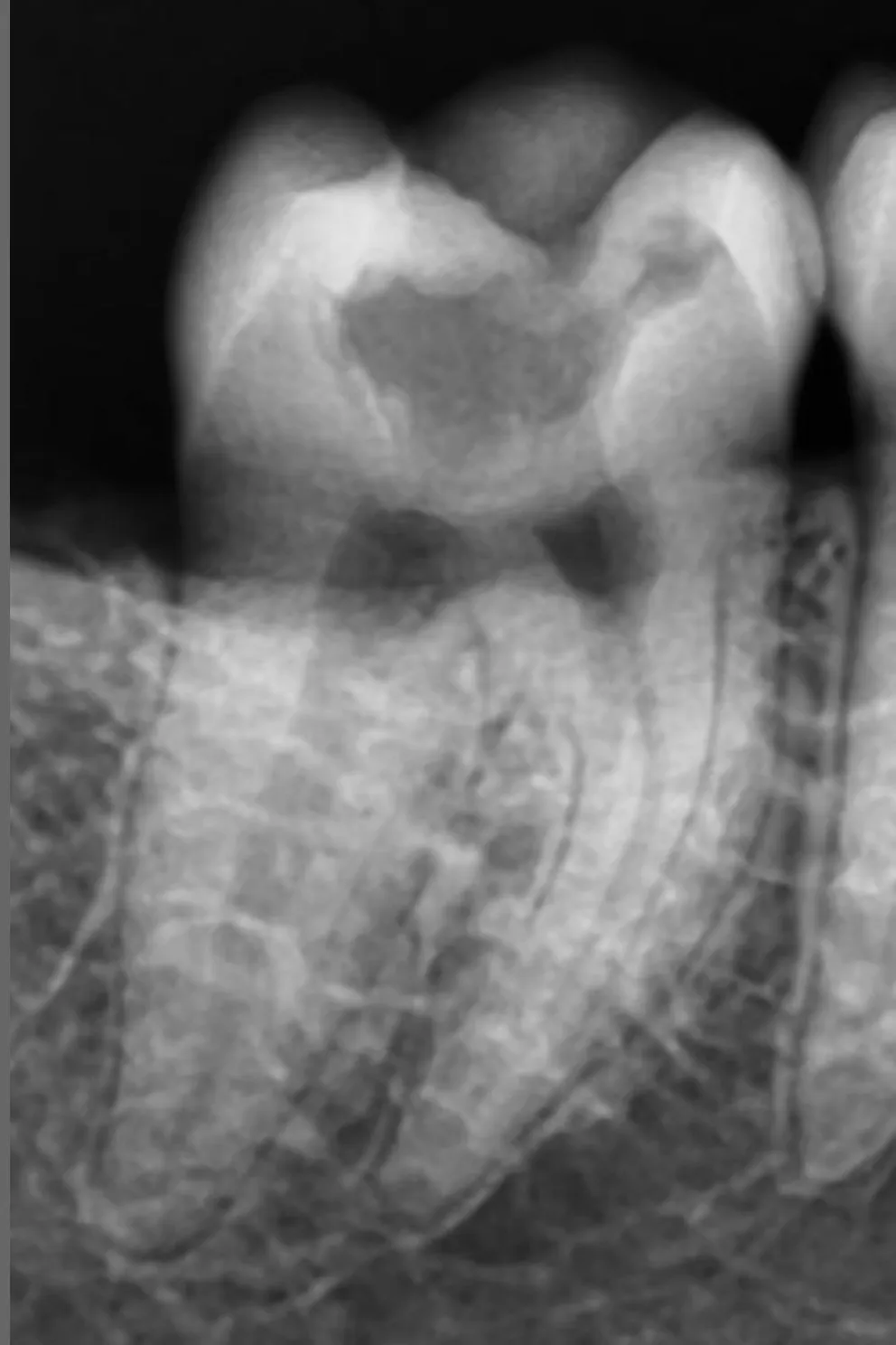 1 - radiografie inițială - carie profundă ocluzală