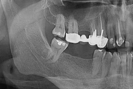1 - Radiografie inițială - 1.3 și 1.4 restaurare protetică necorespunzătoare, pivoți metalici pozitionați excentric, tratamente endodontice anterioare
