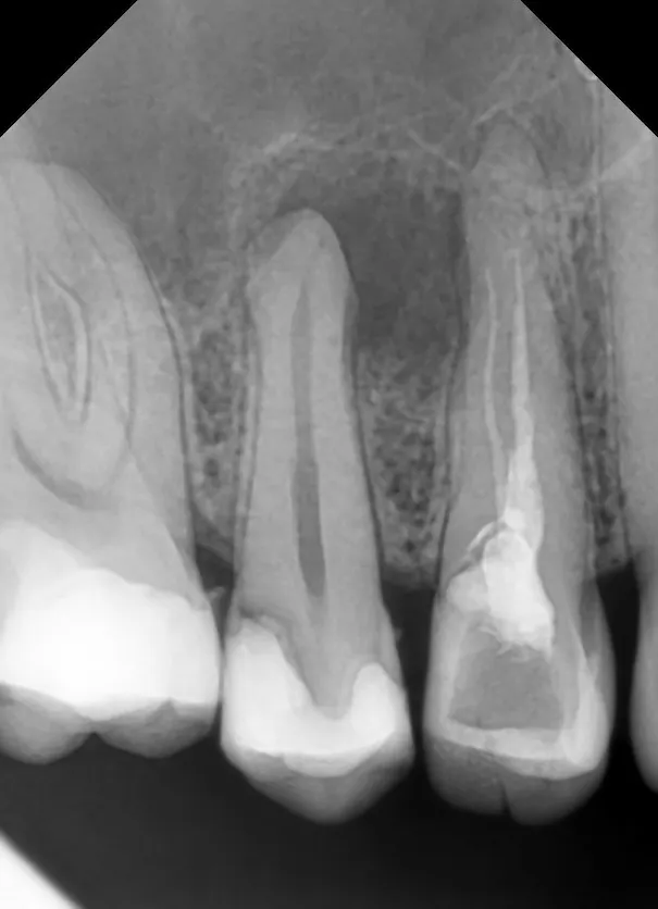 1. Radiografie inițială - parodontită apicală cronică