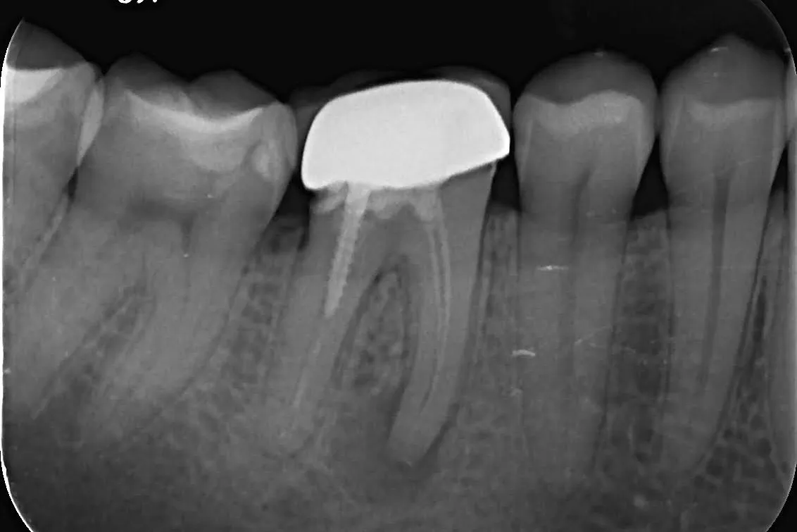 1 - Radiografie inițială. Restaurare protetică cu închidere marginală deficitară. Parodontită apicală cronică reacutizată. Tratament endodontic anterior necorespunzător