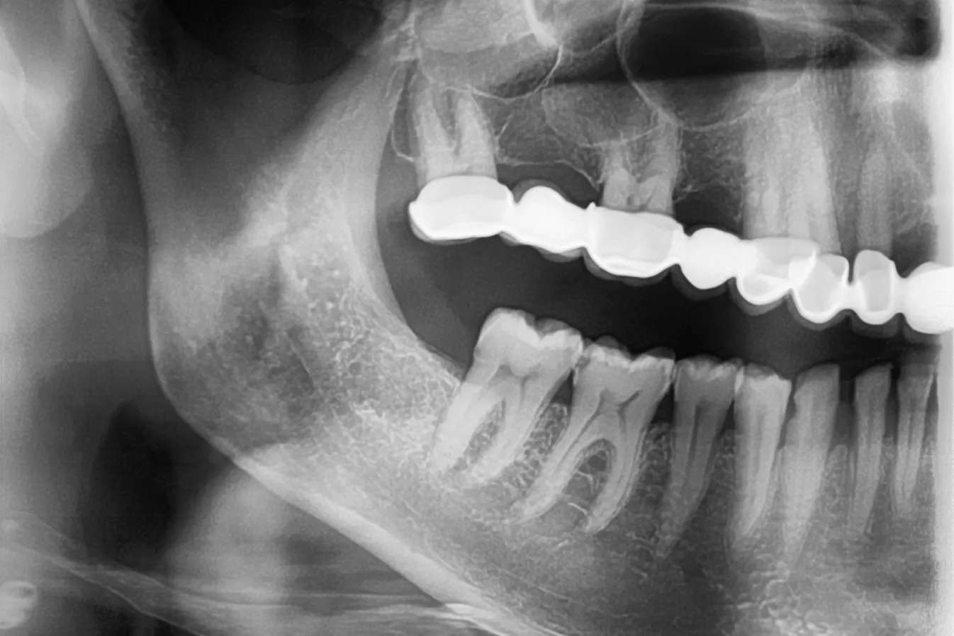 1 - Radiografie inițială 1.6: secțiune OPT, inflamație pulpară ireversibilă (pulpită acută seroasă totală), pulpolit si calcifieri cameră pulpară și canale radiculare