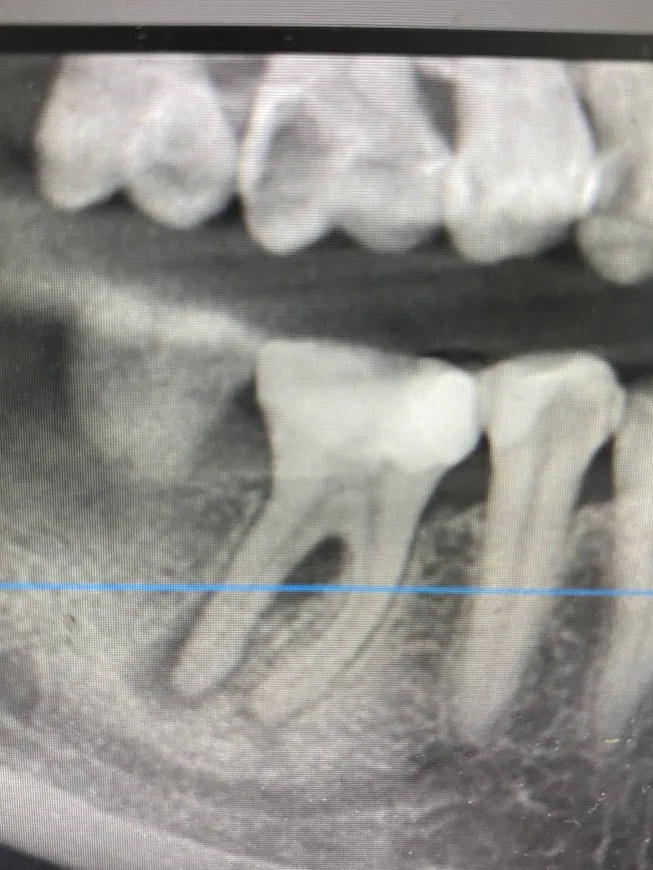 1 - Evaluare imagistică inițială - Secțiune CBCT - tratament endodontic inițiat anterior, parodontită apicală cronică, leziune interradiculară