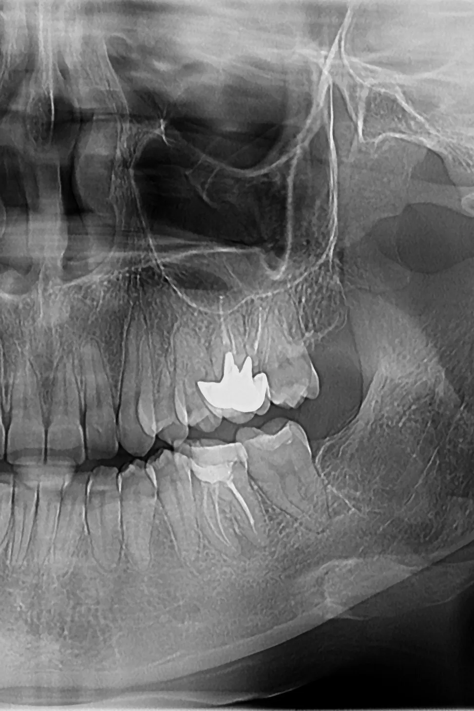 1 - radiografie inițială - 3.6 parodontită apicală cronică, tratament anterior necorespunzător - secțiune OPT