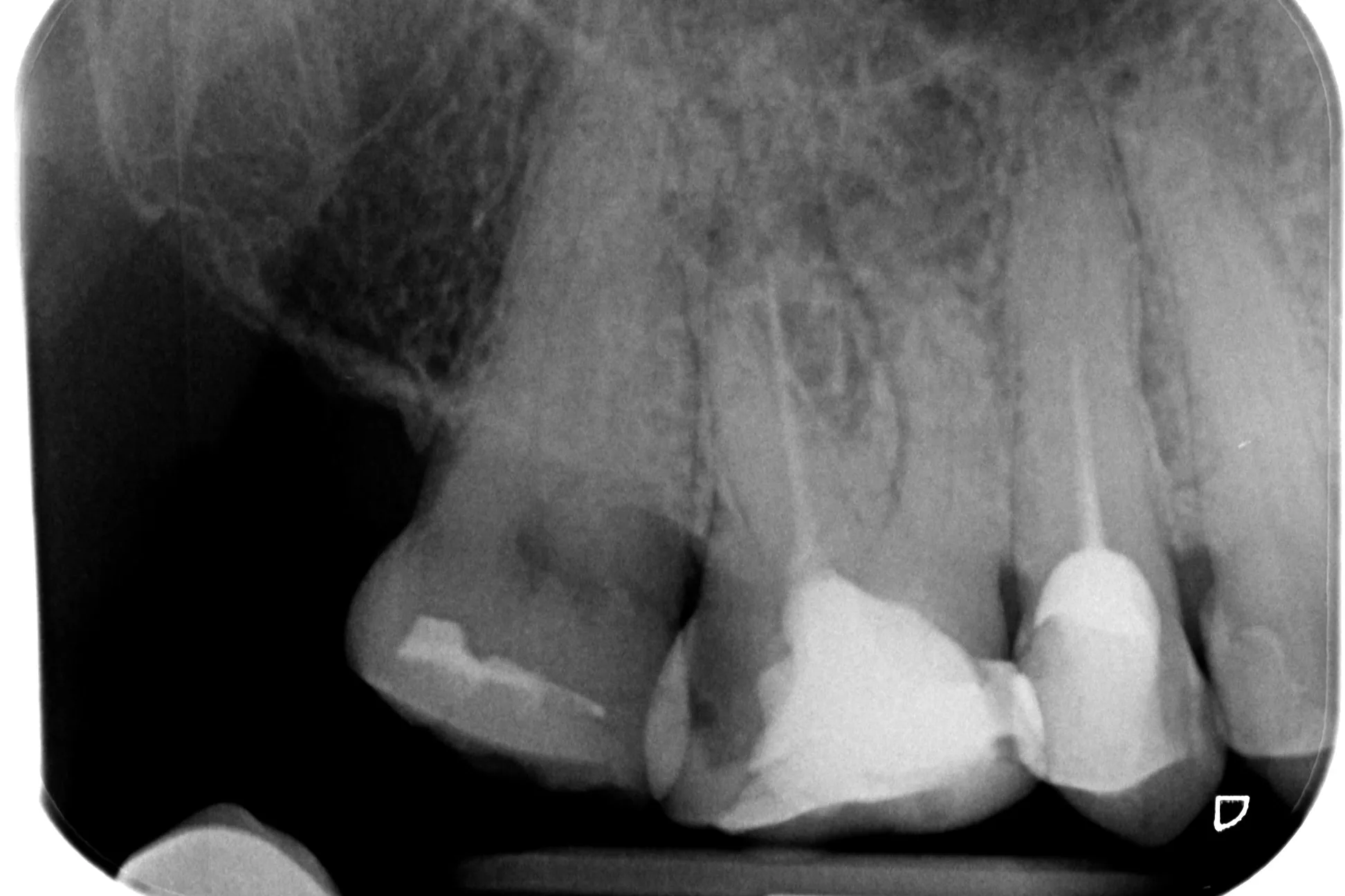 1 - Radiografie inițială 1.6: obturație coronară necorespunzătoare, carie distală profundă, tratament endodontic anterior necorespunzător, parodontită apicală cronică reacutizată