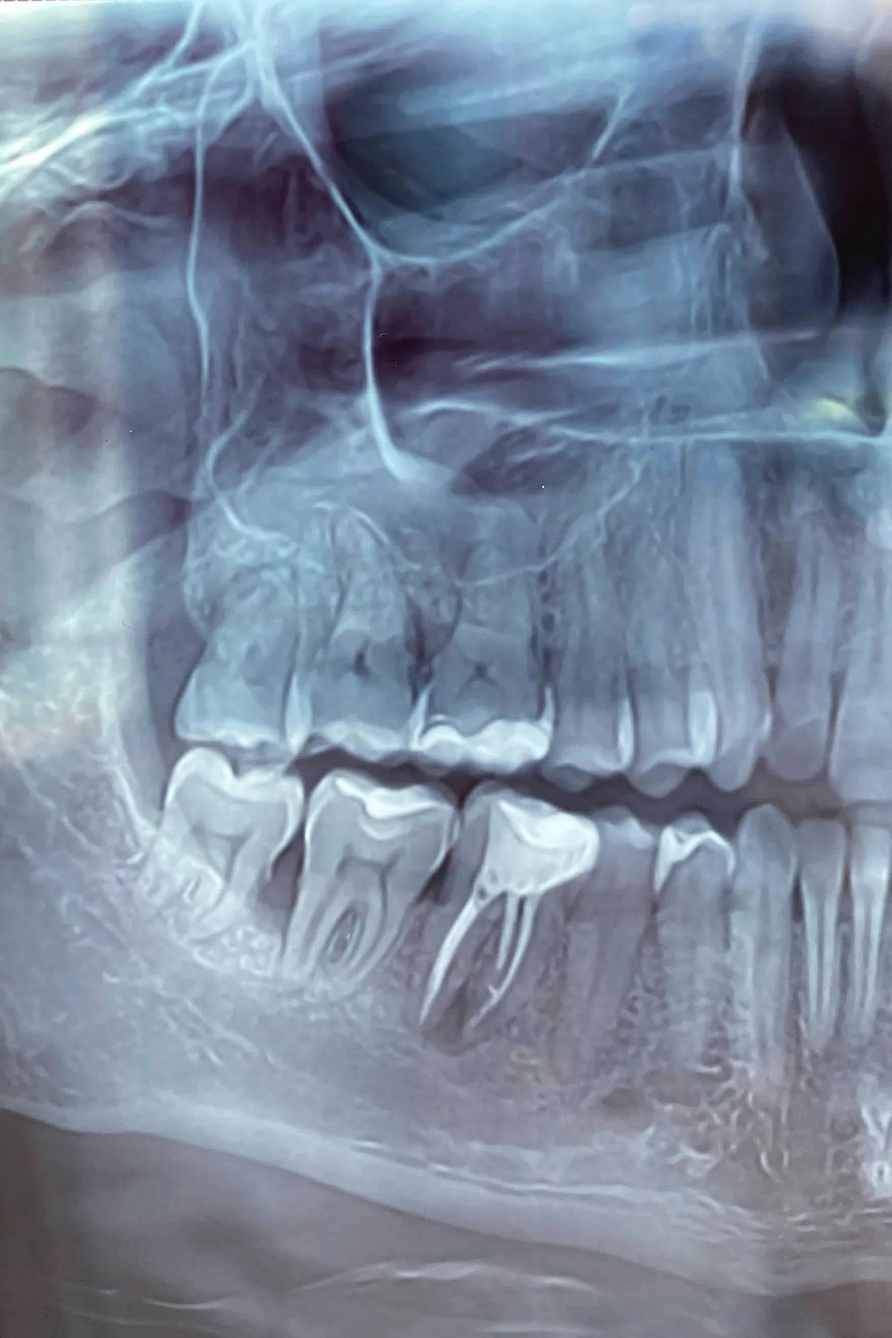 1 - Radiografie inițială - 4.6 tratat anterior, parodontită apicală cronică - secțiune OPT