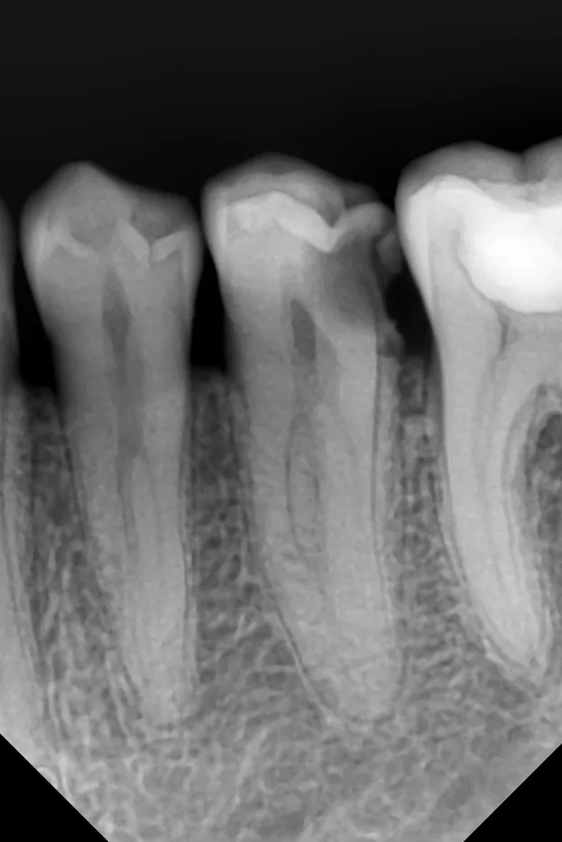 1 - radiografie inițială