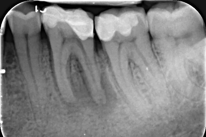 1 - Radiografie inițială 3.6: coafaj direct realizat anterior, parodontită apicală acută