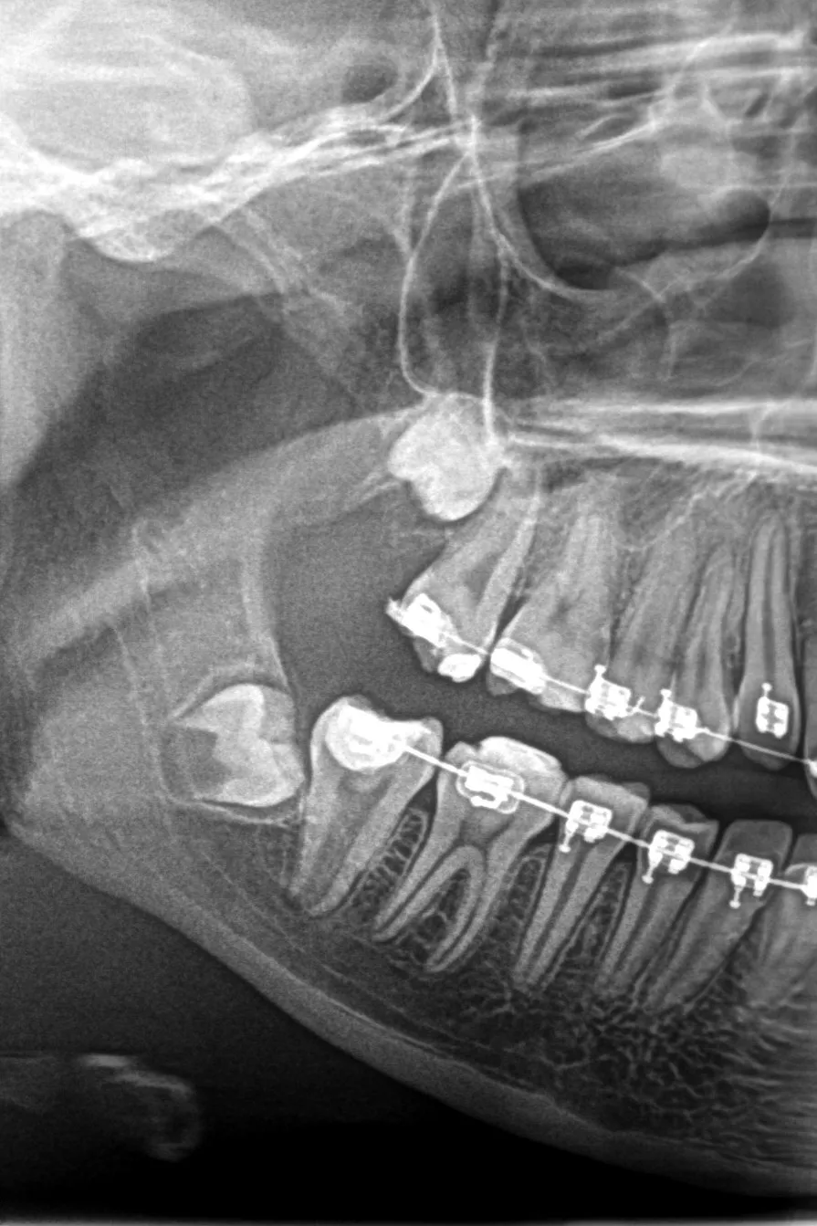1 - radiografie inițială - secțiune OPT - 4.7 anomalie de formă, un singur canal, apex incomplet format, aparat ortodontic. Inflamație pulpară ireversibilă pe tot volumul pulpar