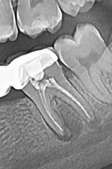 1.a - radiografie inițială - dinte tratat anterior, restaurare protetică necorespunzătoare, parodontită apicală cronică reacutizată