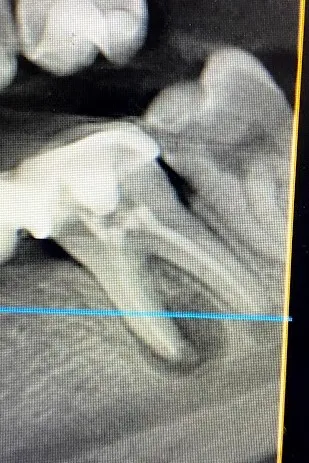 1.b - secțiune CBCT - status inițial