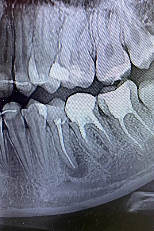1 - radiografie inițială - secțiune OPT - parodontită apicală cronică la nivelul premolarului inferior 3.5 și molarului 3.6 ; tratamente anterioare necorespunzătoare, patologie reacutizată