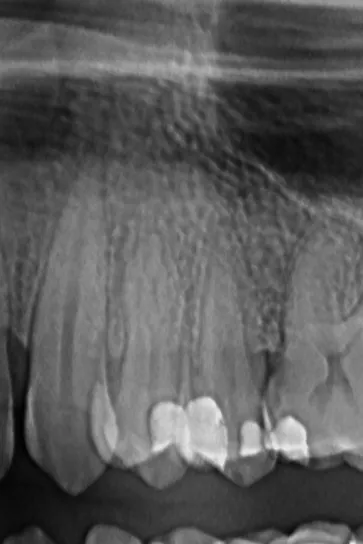 1 - radiografie inițială - secțiune din radiografie panoramică