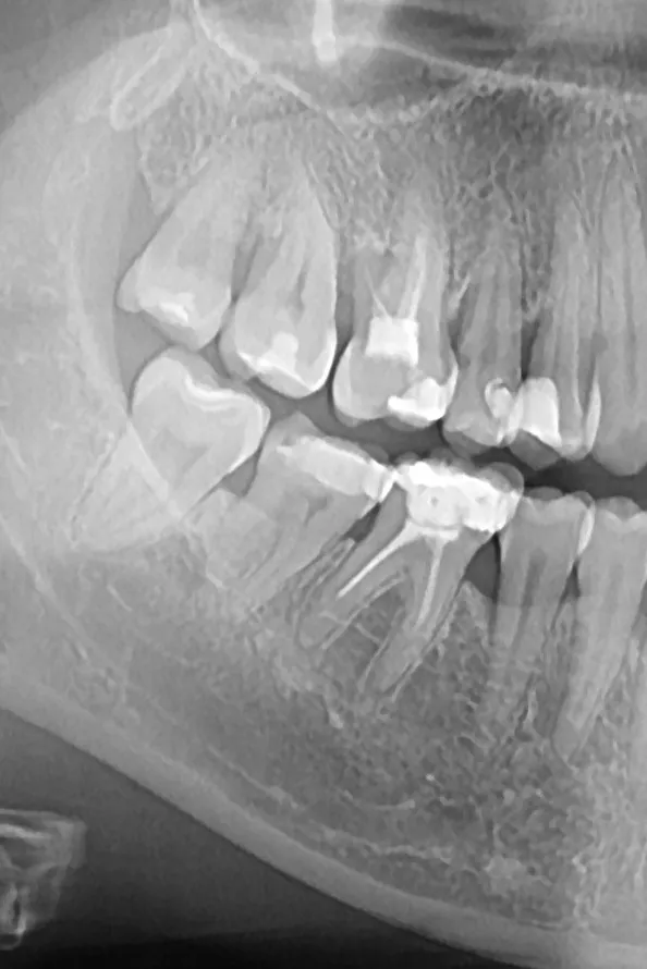1 - radiografie inițială -  secțiune OPT - 4.6 parodontită apicală cronică, 4.7 obturație profundă cu carie secundară și recidivă, inflamație pulpară ireversibilă