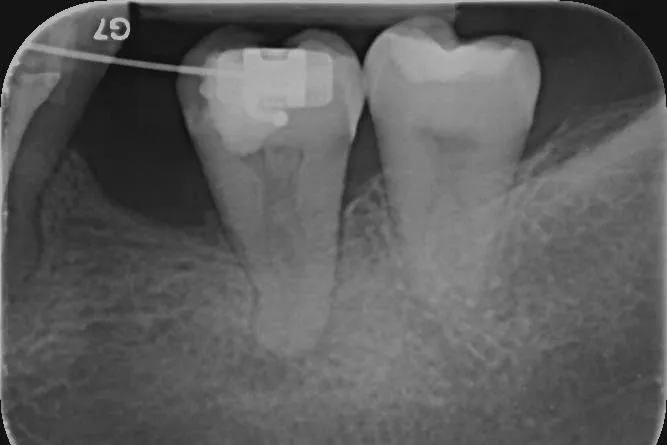 1 - Radiografie inițială - parodontită apicală acută, tratament de urgență inițiat anterior, aparat ortodontic