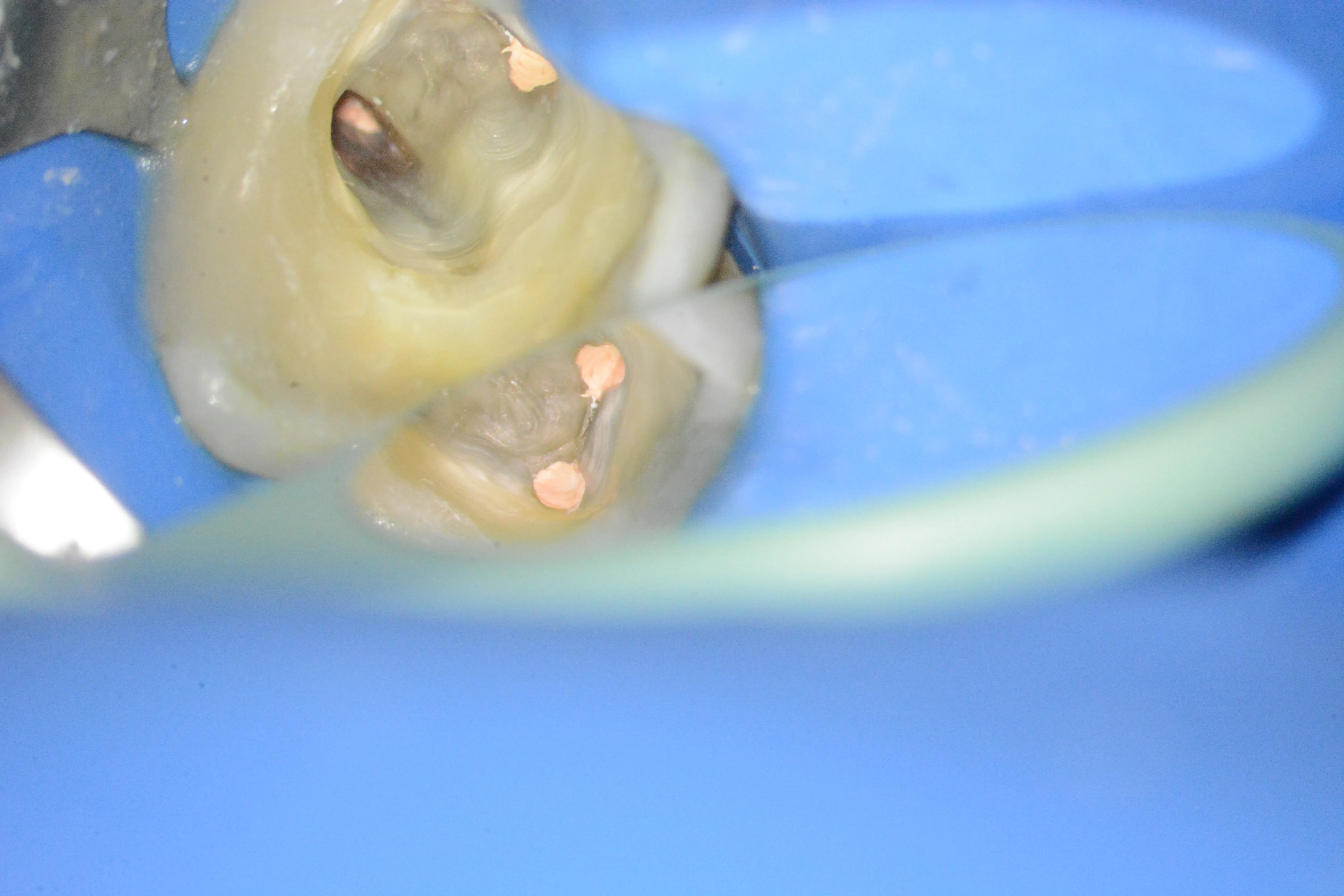 10 – Obturarea canalelor radiculare