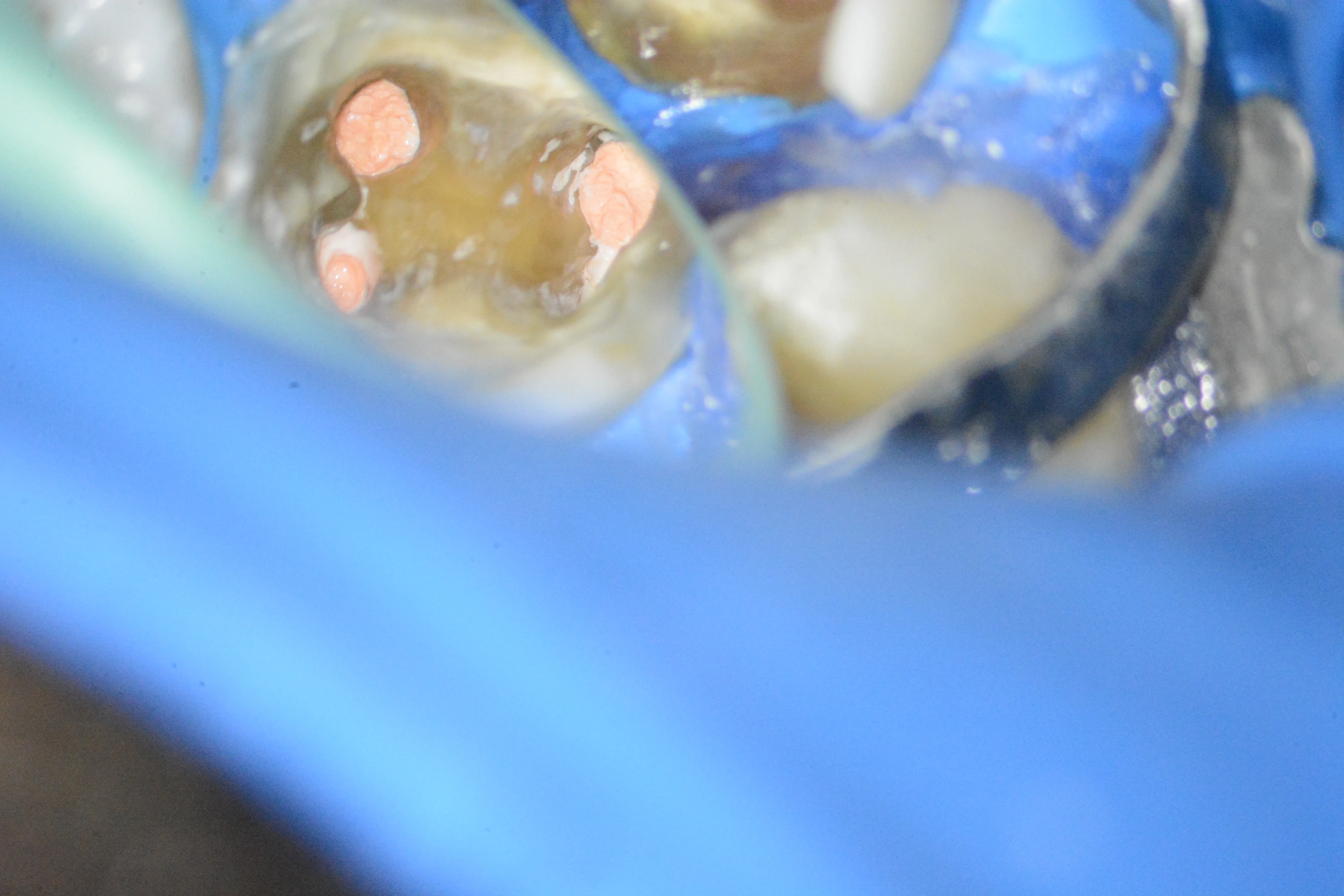 10 – Aspectul clinic după finalizarea tratamentului endodontic