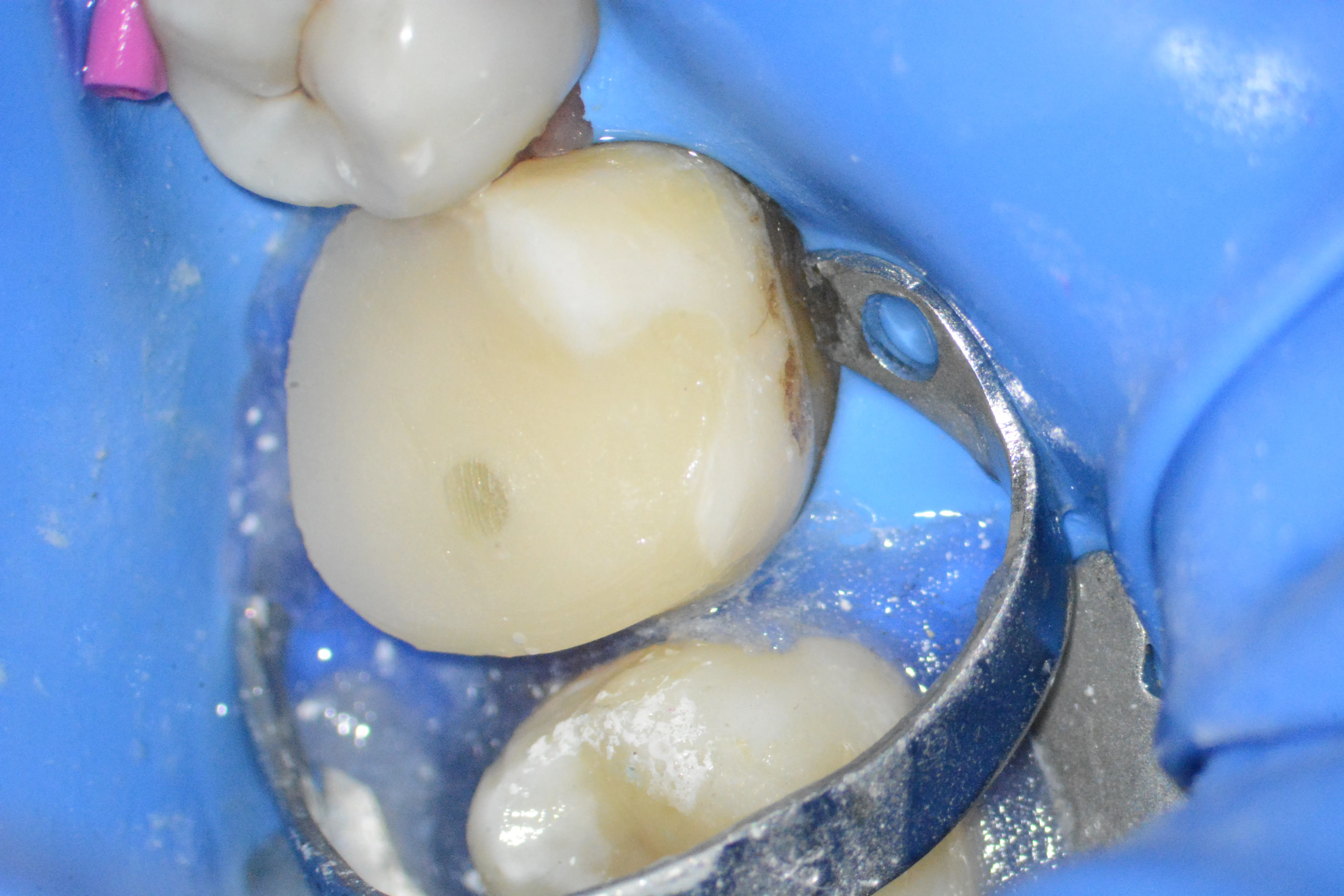 11 – Reconstrucția corono-radiculară