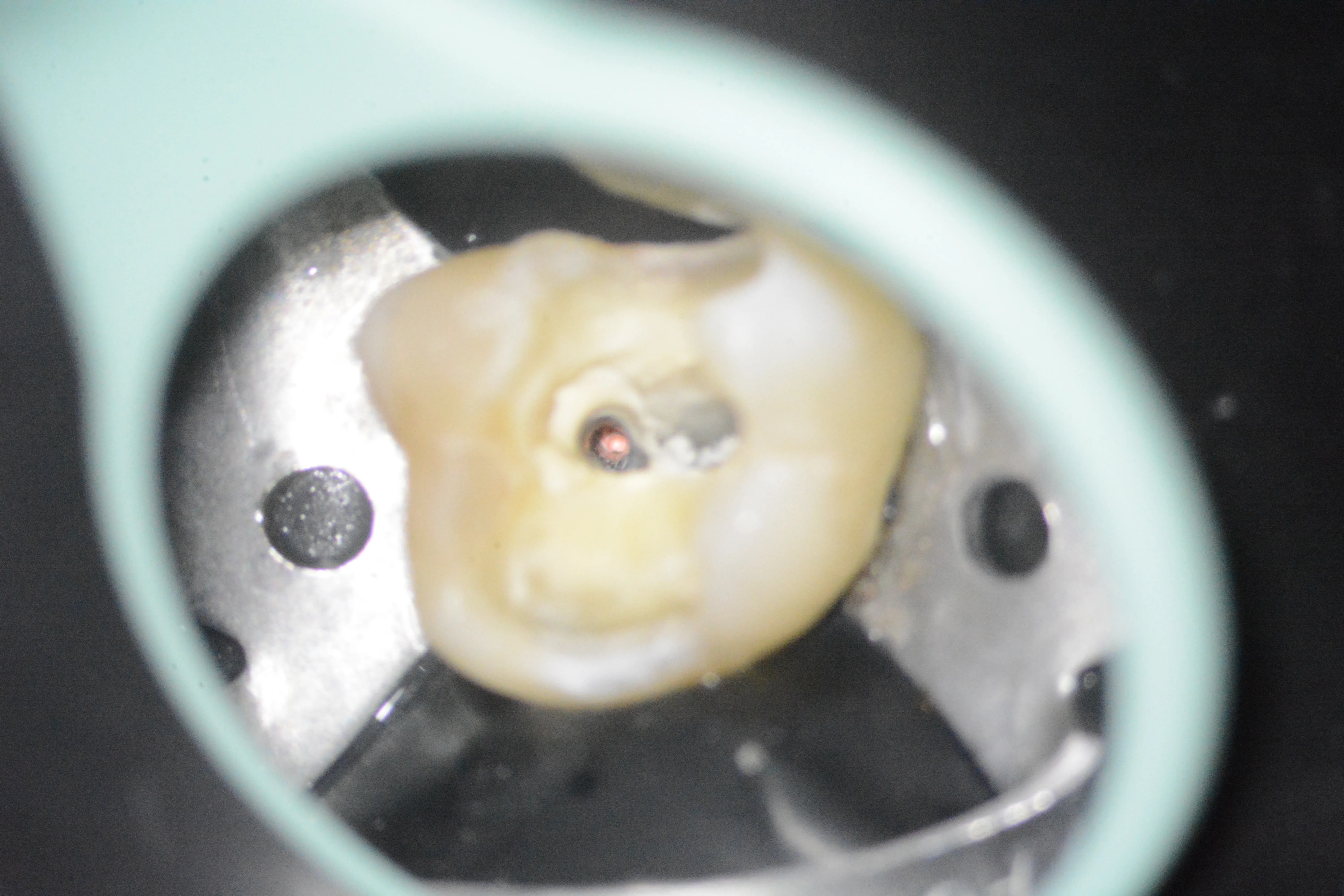 11 – Obturarea canalului palatinal