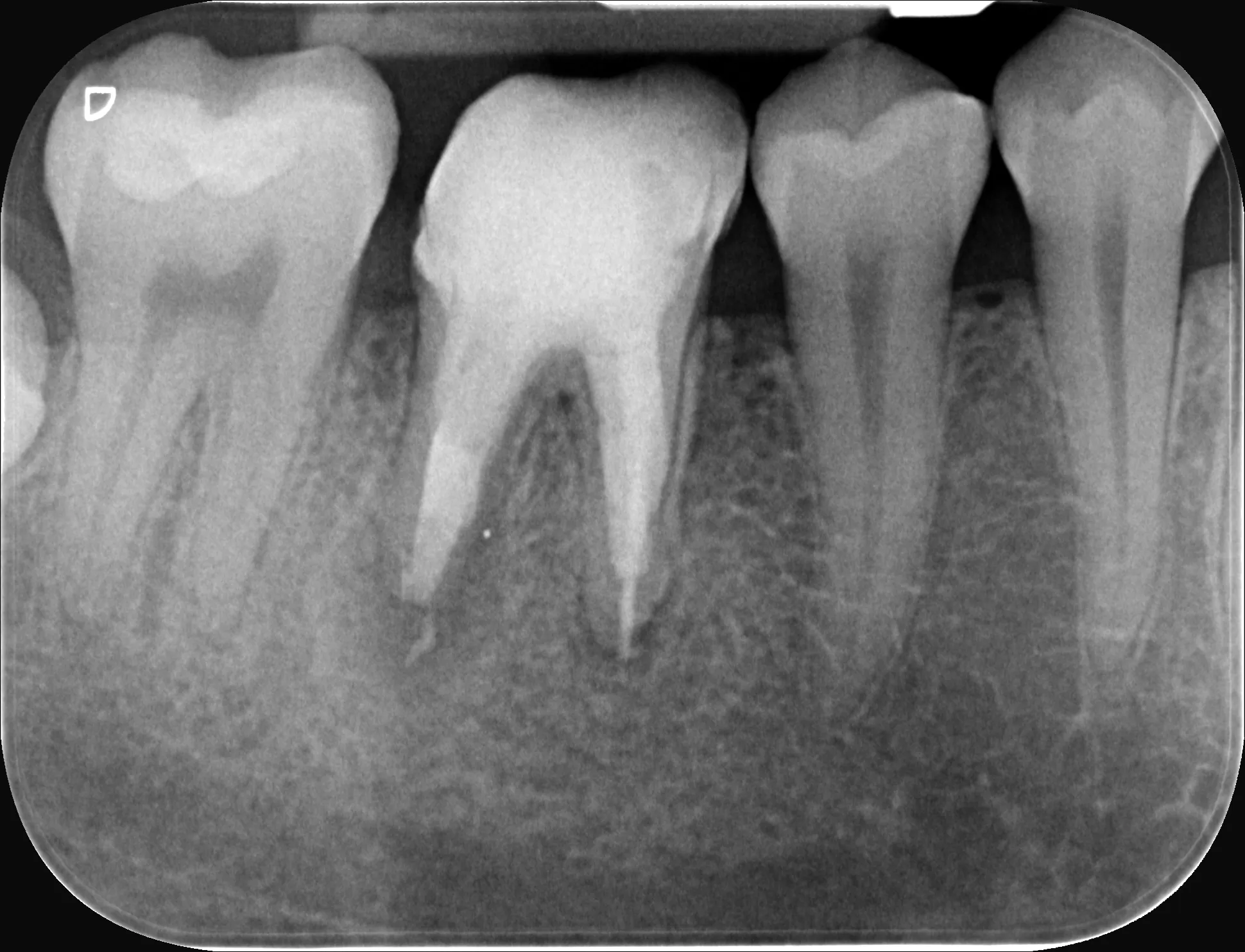12 – Radiografia de control imediat după finalizarea tratamentului endodontic