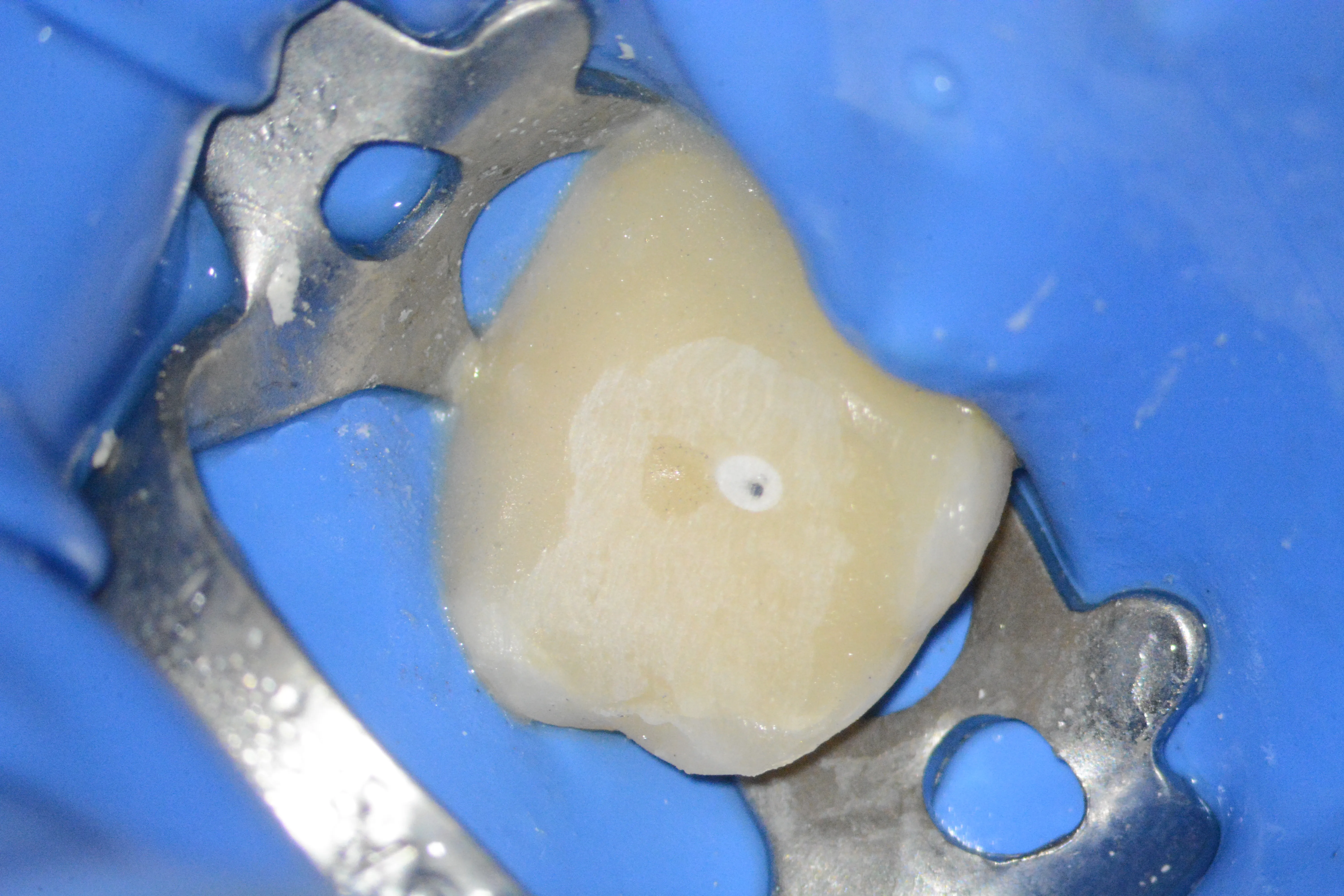 13 – Aspectul final al reconstrucției corono-radiculare înainte de adaptarea în ocluzie