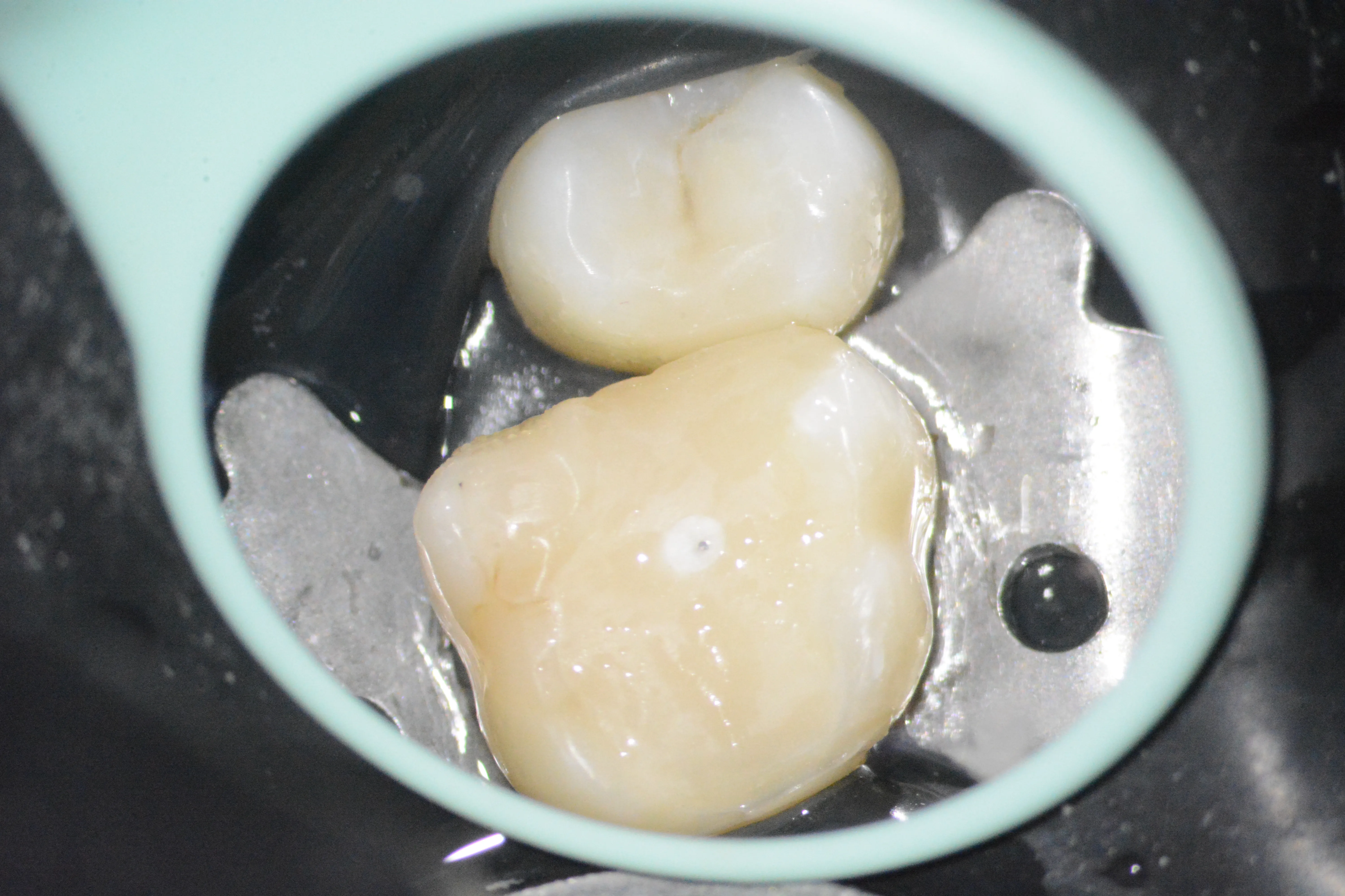 14 – Reconstrucția corono-radiculară