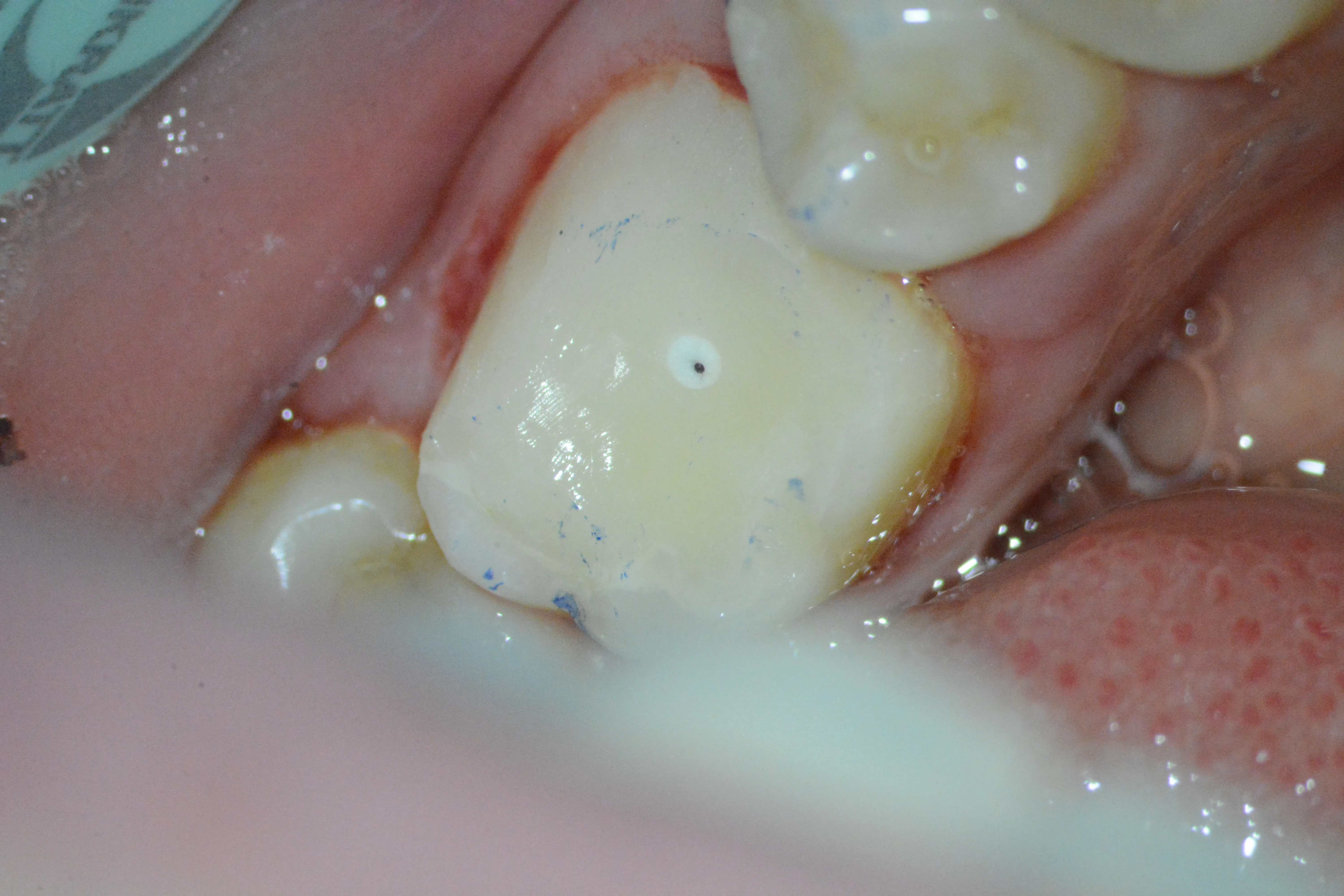 14 – Aspectul final al reconstrucției corono-radiculare după finisare