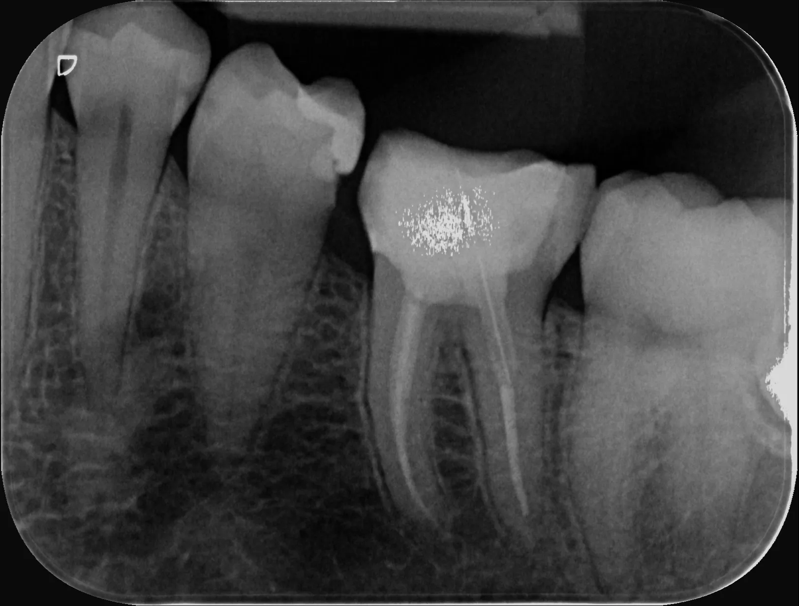 15 – Radiografia de control imediat post-operator