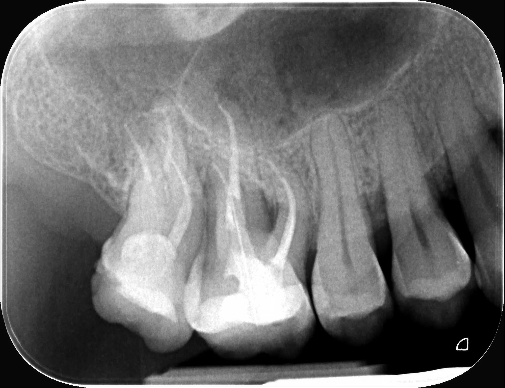 15 – Radiografia de control imediat după finalizarea tratamentului