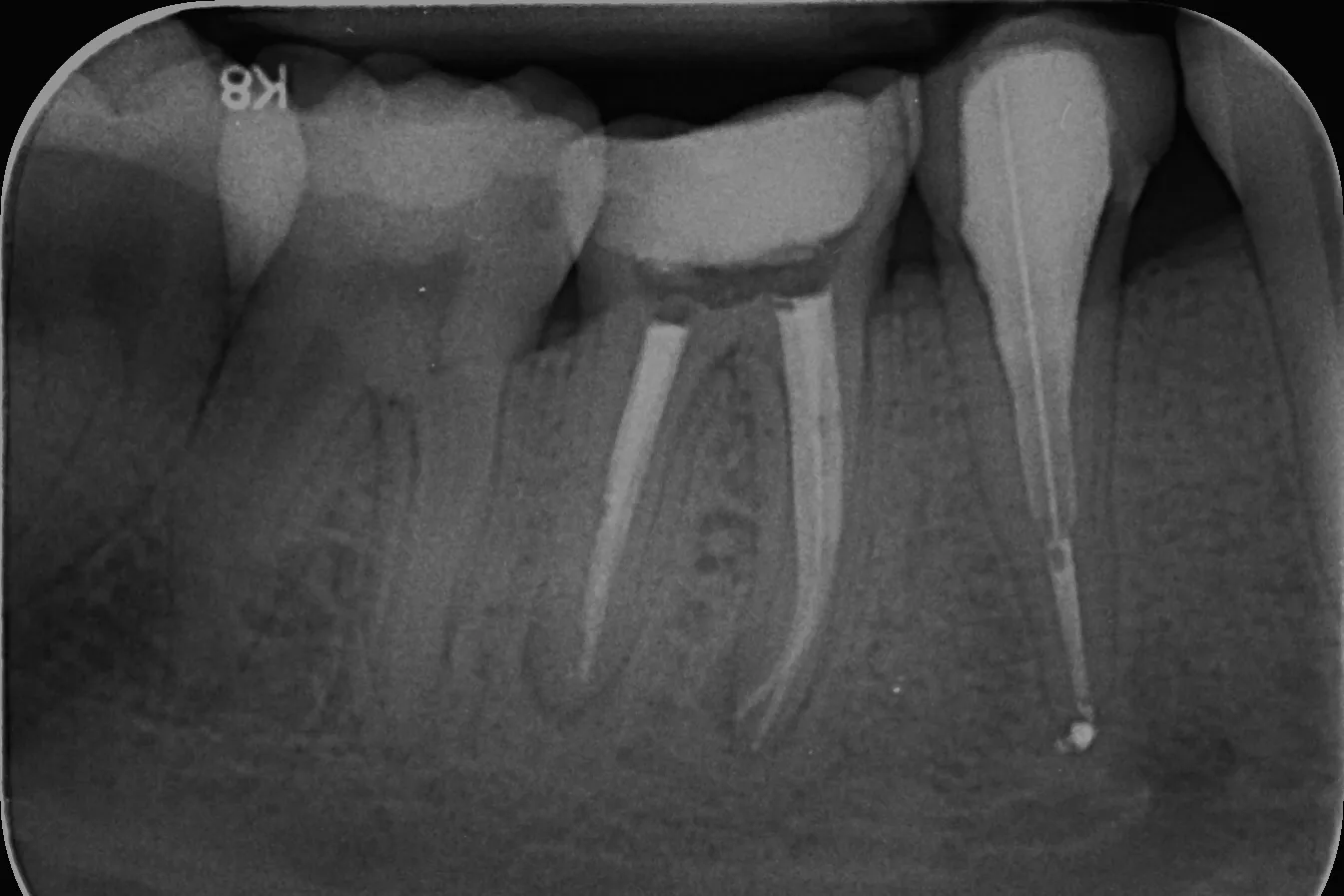 2 - Radiografie de control după finalizarea retratamentului - ortoradial