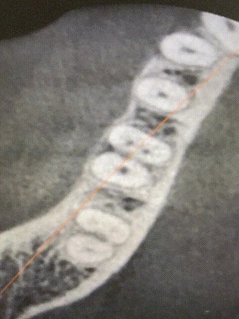 2 - Evaluare imagistică inițială - Secțiune CBCT - aspectul perforației la nivelul rădăcinii distale