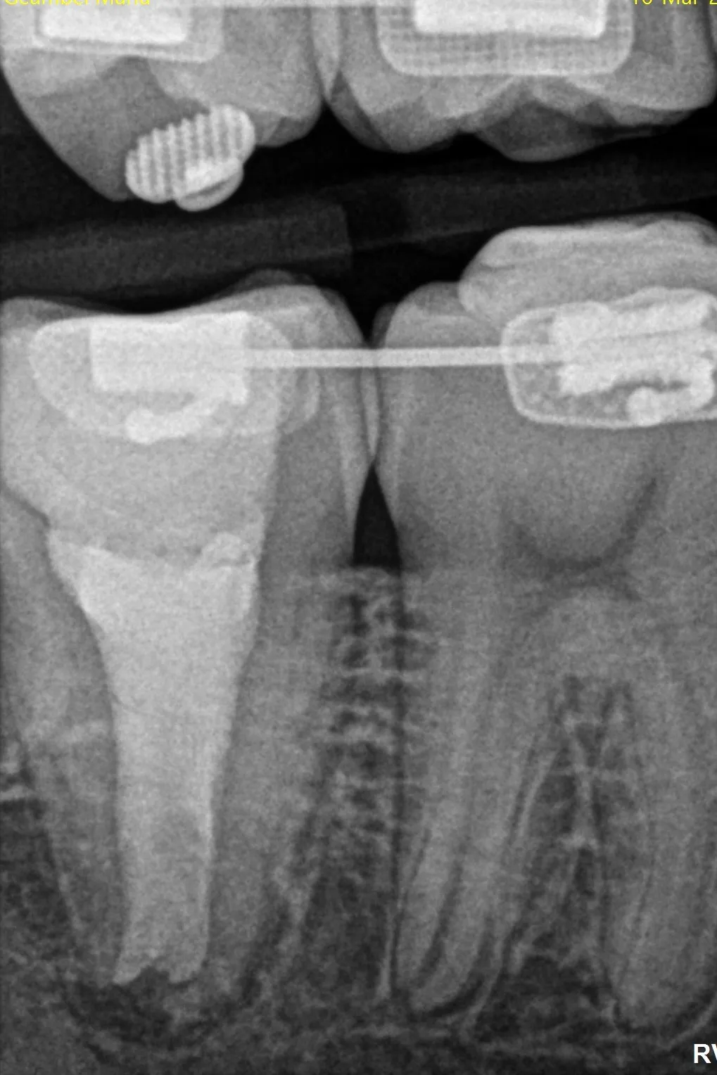 2 - radiografie de control imediat după finalizarea tratamentului endodontic - MTA compactat apical