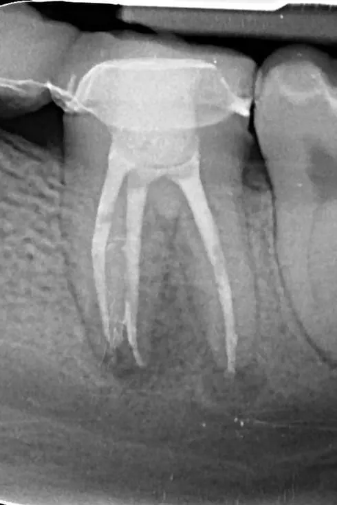 2- radiografie de control imediat după finalizarea retratamentului endodontic și realizarea unei restaurări protetice provizorie realizată în cabinet