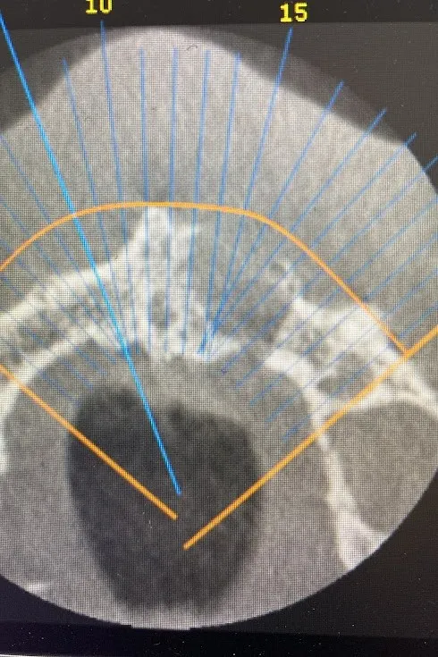 2 - Secțiune inițială CBCT axială