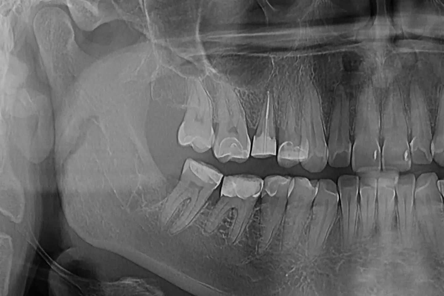 2 - Radiografie de control la 2 luni după finalizarea retratamentului endodontic 1.5: ablație și îndepărtare DCR, retratament endodontic, reconstrucție corono-radiculară, leziune periapicală în proces de vindecare
