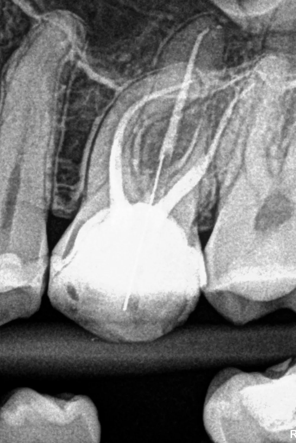 2 - Radiografie de control după terminarea tratamentului si a reconstrucției corono-radiculare