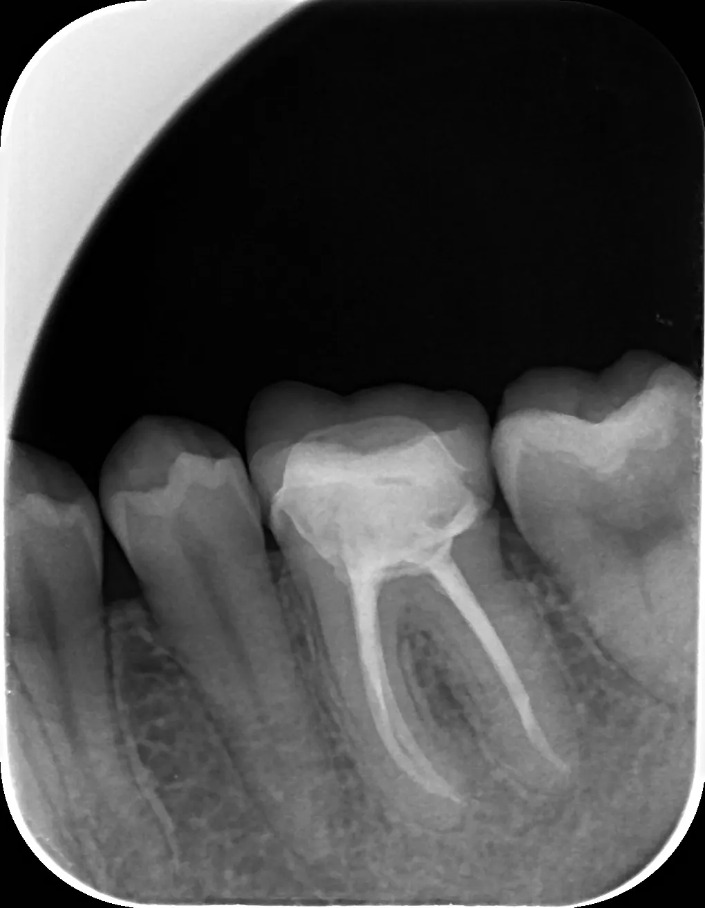 2 - radiografie de control la 6 luni de la finalizarea tratamentului - vindecare leziune periapicală