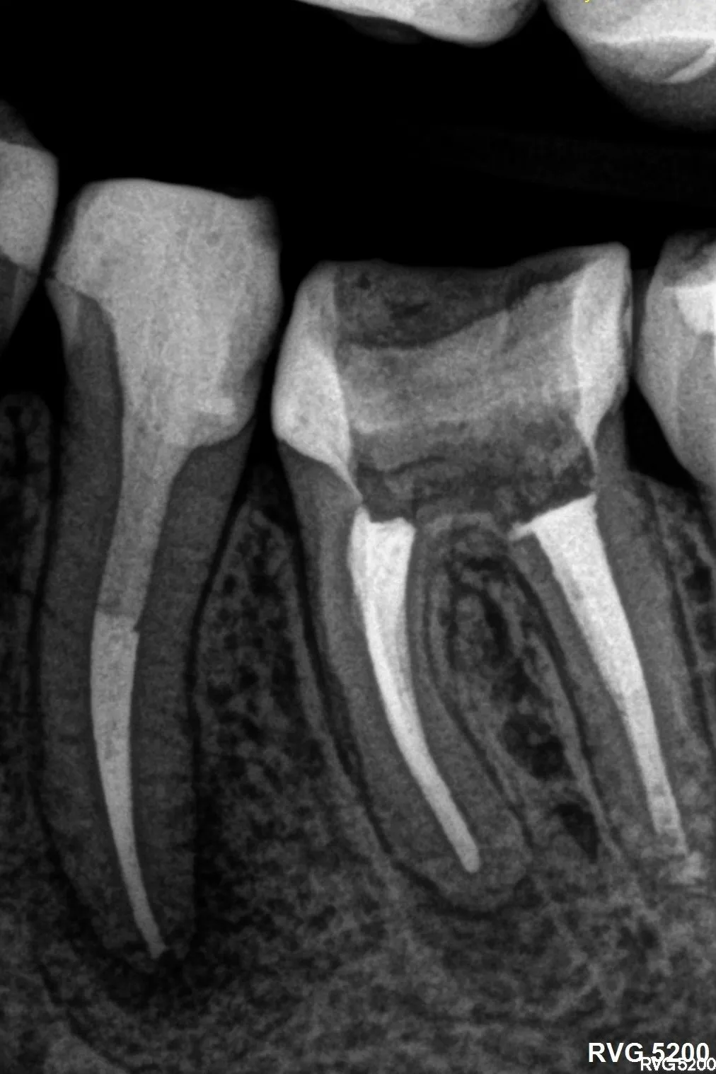 2 - radiografie de control după finalizarea tratamentelor  - ortoradial