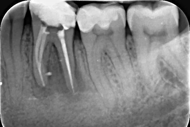 2 - Radiografie de control imediat după finalizarea tratamentului endodontic