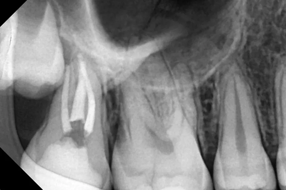 2 - Radiografie de control la finalizarea tratamentului endodontic. Compactare MTA apical pe fiecare canal și injectare gutapercă