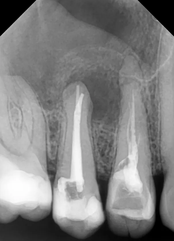 2. Radiografie de control după realizarea tratamentului endodontic la nivelul celui de-al doilea premolar superior