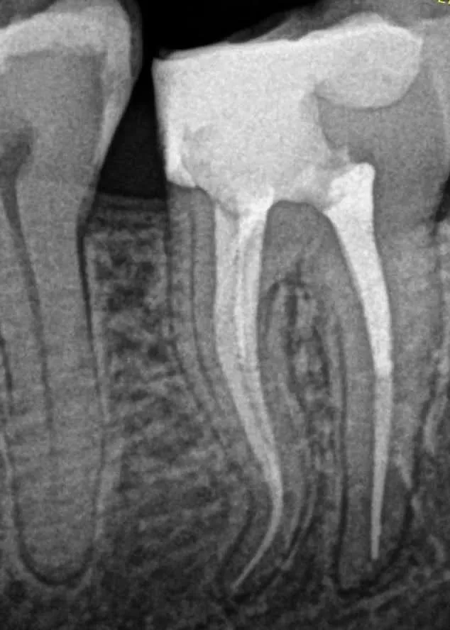 2 - Radiografie de control: imediat după finalizarea tratamentului, build-up coronar