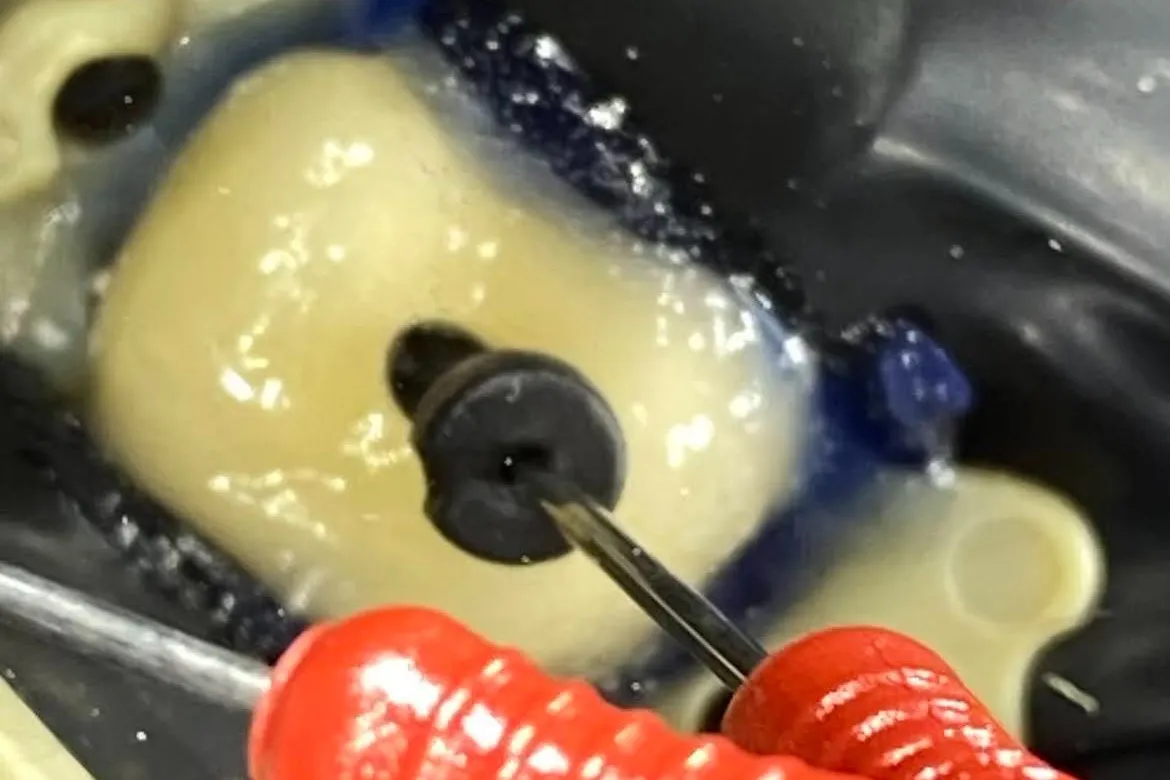 2 - Aspect în timpul tratamentului endodontic