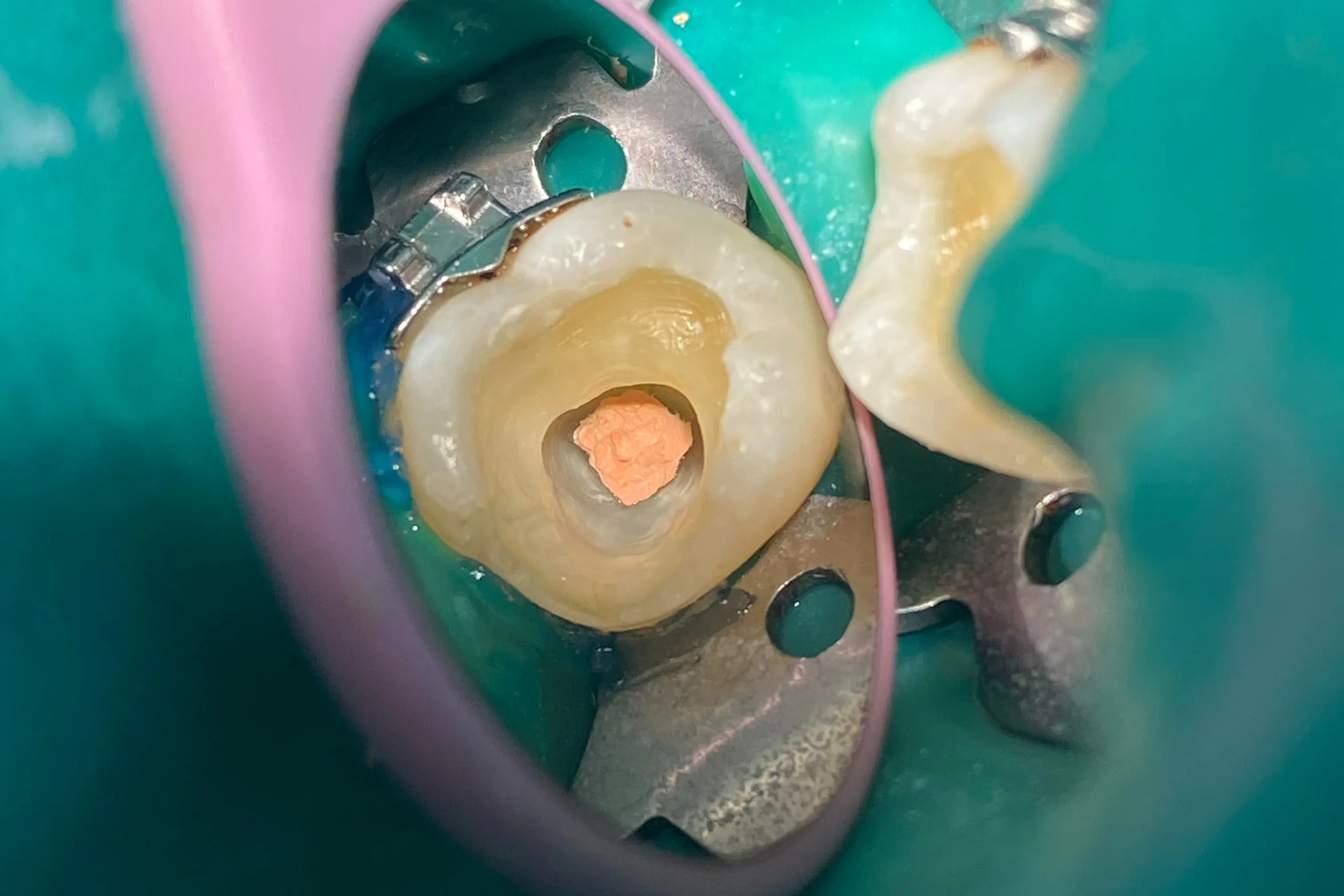 2 - Intraoperator în momentul finalizării tratamentului endodontic