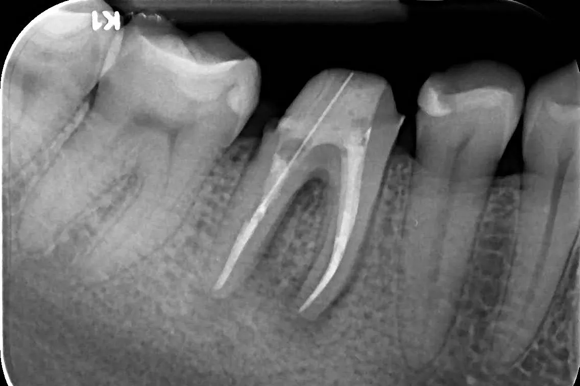 2 - Radiografie de control imediat după finalizarea retratamentului endodontic și a reconstrucției corono-radiculare