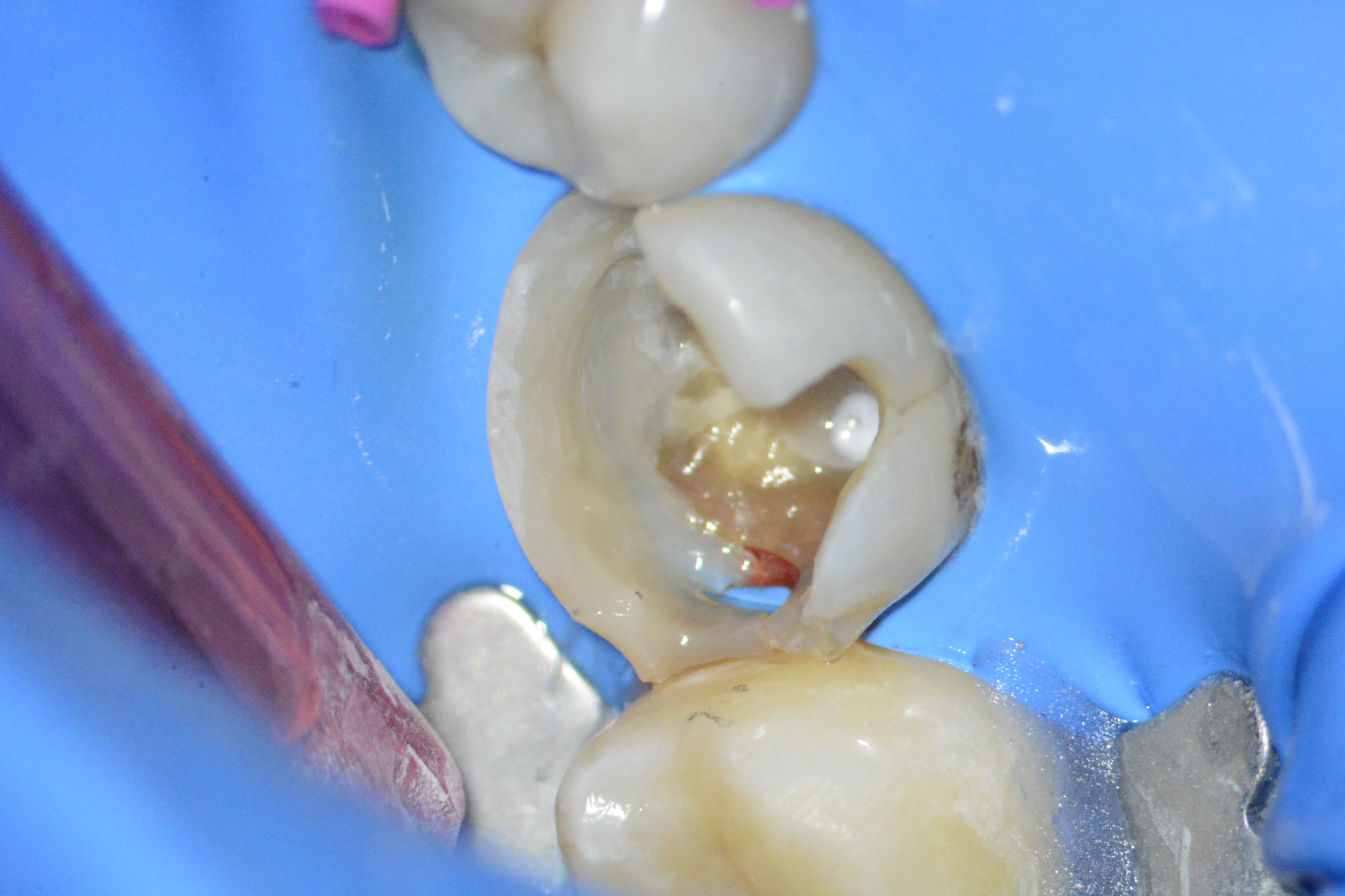 2 – Aspectul după dezasamblarea coronară parțială