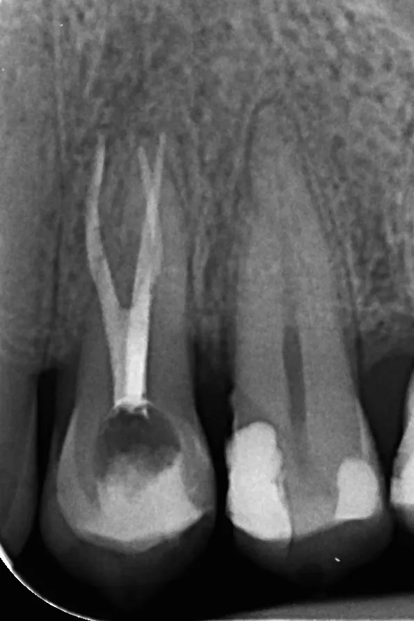 2.a - radiografie de control după finalizarea tratamentului la nivelul dintelui 2.4 - ortoradial